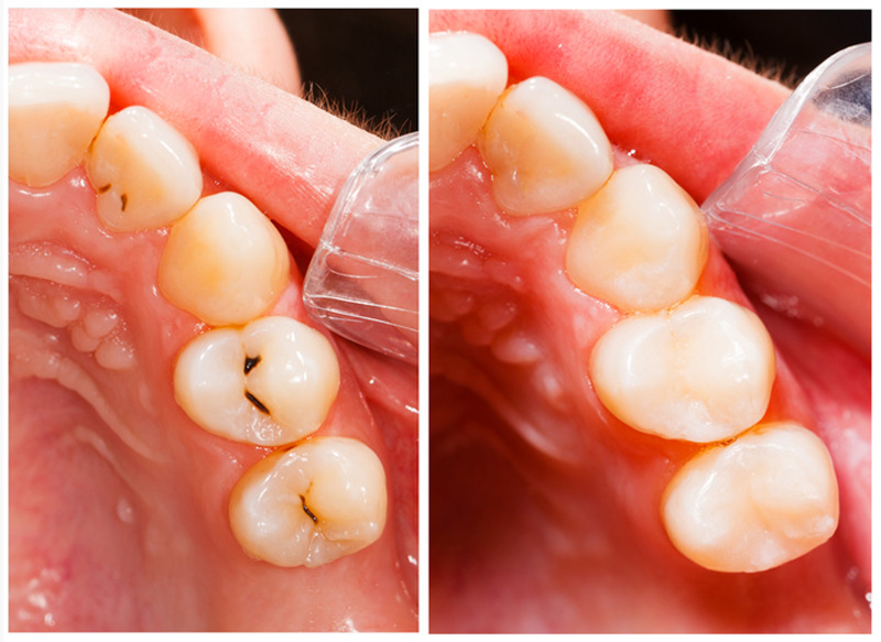 Fillings  Grand Prairie, TX 